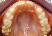 high fevers and teeth discoloration