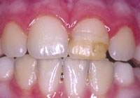 bottom teeth losing enamel