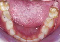 weak enamel children's teeth
